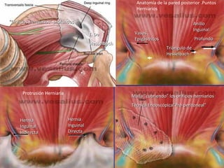 Malla “cubriendo” los orificios herniariosMalla “cubriendo” los orificios herniarios
Técnica Endoscópica“Pre-peritoneal”Técnica Endoscópica“Pre-peritoneal”
HerniaHernia
InguinalInguinal
DirectaDirecta
HerniaHernia
InguinalInguinal
IndirectaIndirecta
Protrusión Herniaria
Triángulo deTriángulo de
HesselbachHesselbach
VasosVasos
EpigástricosEpigástricos
AnilloAnillo
InguinalInguinal
ProfundoProfundo
Anatomía de la pared posterior .Puntos
Herniarios
T. DeT. De
HesselbachHesselbach
““Orificios Herniarios” profundosOrificios Herniarios” profundos
 