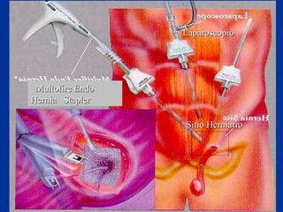 Sitio HerniarioSitio Herniario
LaparoscopioLaparoscopio
Multofire EndoMultofire Endo
Hernia StaplerHernia Stapler
 