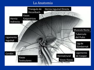 Hernia Inguinal DirectaTriangulo de
Hesselbach
Vasos
EpigastricosHernia
Indirecta
Ligamento
Inguinal
Cordón
Vasos
Testiculares Vasos Iliacos
HerniaCrural
Ligamento
de Cooper
Lig.de
Gimbernat
Tuberculo
del Pubis
Musculo Recto
La Anatomia
 
