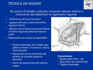 TÉCNICA DE BASSINI
– Aislamiento del saco herniario
– Ligadura del saco a nivel del orificio
inguinal interno
– Apertura de la fascia transversal desde
el orificio inguinal profundo hasta el
pubis
– Reparación con sutura no absorbible
• Puntos separados de la triple capa
(Oblicuo menor, Transverso, Fascia
Transversalis)
• Reposición de los elementos del
cordón en la pared posterior
formada
• Cierre de aponeurosis del oblicuo
mayor
Comentarios:
• Mucho dolor Post – Op
• Alto Grado de recurrencias
• Tejidos Anormales
Se sutura el tendón conjunto (músculo oblicuo interno y
transverso del abdomen) al ligamento inguinal.
 