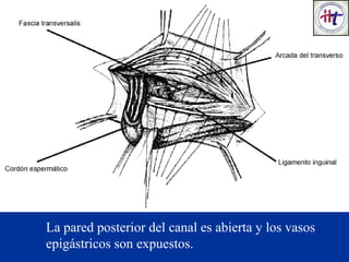 La pared posterior del canal es abierta y los vasos
epigástricos son expuestos.
 