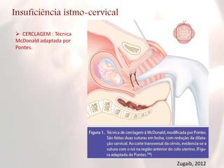 Insuficiência istmo-cervical
 CERCLAGEM : Técnica
McDonald adaptada por
Pontes.
Zugaib, 2012
 