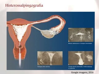 Histerossalpingografia
Google imagens, 2016
 