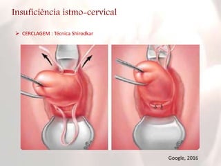 Insuficiência istmo-cervical
 CERCLAGEM : Técnica Shirodkar
Google, 2016
 