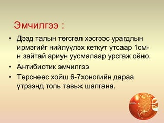 Эмчилгээ :
• Дээд талын төгсгөл хэсгээс урагдлын
ирмэгийг нийлүүлэх кеткут утсаар 1см-
н зайтай ариун уусмалаар урсгаж оёно.
• Антибиотик эмчилгээ
• Төрснөөс хойш 6-7хоногийн дараа
үтрээнд толь тавьж шалгана.
 