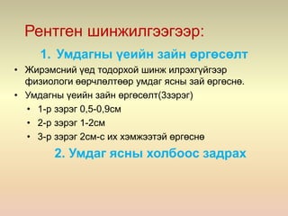 Рентген шинжилгээгээр:
1. Умдагны үеийн зайн өргөсөлт
• Жирэмсний үед тодорхой шинж илрэхгүйгээр
физиологи өөрчлөлтөөр умдаг ясны зай өргөснө.
• Умдагны үеийн зайн өргөсөлт(3зэрэг)
• 1-р зэрэг 0,5-0,9см
• 2-р зэрэг 1-2см
• 3-р зэрэг 2см-с их хэмжээтэй өргөснө
2. Умдаг ясны холбоос задрах
 