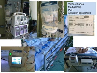 Varón 73 años
Mediastnitis
PCR
Agitación postparada
 
