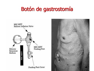 Botón de gastrostomía
 