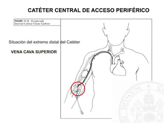 CATÉTER CENTRAL DE ACCESO PERIFÉRICO
Situación del extremo distal del Catéter
VENA CAVA SUPERIOR
 