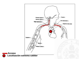 Acceso
Localización extremo catéter
 