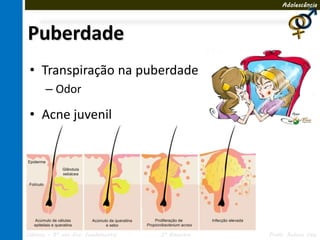 Adolescência




Puberdade
 • Transpiração na puberdade
       – Odor

 • Acne juvenil




Ciências – 8º ano Ens. Fundamental   3º Bimestre   Profa. Rebeca Vale
 