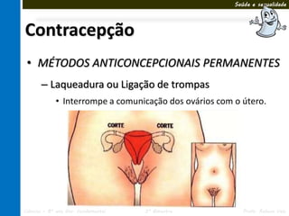 Saúde e sexualidade




Contracepção
 • MÉTODOS ANTICONCEPCIONAIS PERMANENTES
       – Laqueadura ou Ligação de trompas
             • Interrompe a comunicação dos ovários com o útero.




Ciências – 8º ano Ens. Fundamental   3º Bimestre           Profa. Rebeca Vale
 