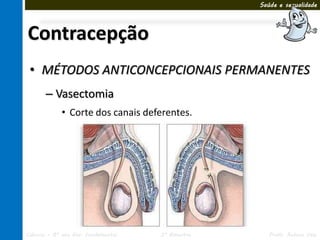 Saúde e sexualidade




Contracepção
 • MÉTODOS ANTICONCEPCIONAIS PERMANENTES
       – Vasectomia
             • Corte dos canais deferentes.




Ciências – 8º ano Ens. Fundamental   3º Bimestre      Profa. Rebeca Vale
 