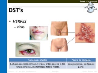 Saúde e sexualidade




DST’s
 • HERPES
       – vírus




                         Sintomas e efeitos                       Forma de contágio
  Bolhas nos órgãos genitais. Feridas, ardor, coceira e dor.   Contato sexual. Gestação e
       Retardo mental, malformação fetal e morte.                        parto.
Ciências – 8º ano Ens. Fundamental            3º Bimestre                    Profa. Rebeca Vale
 
