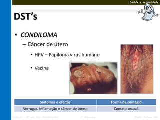 Saúde e sexualidade




DST’s
 • CONDILOMA
       – Câncer de útero
             • HPV – Papiloma vírus humano

             • Vacina




                    Sintomas e efeitos                 Forma de contágio
       Verrugas. Inflamação e câncer de útero.          Contato sexual.

Ciências – 8º ano Ens. Fundamental       3º Bimestre                Profa. Rebeca Vale
 