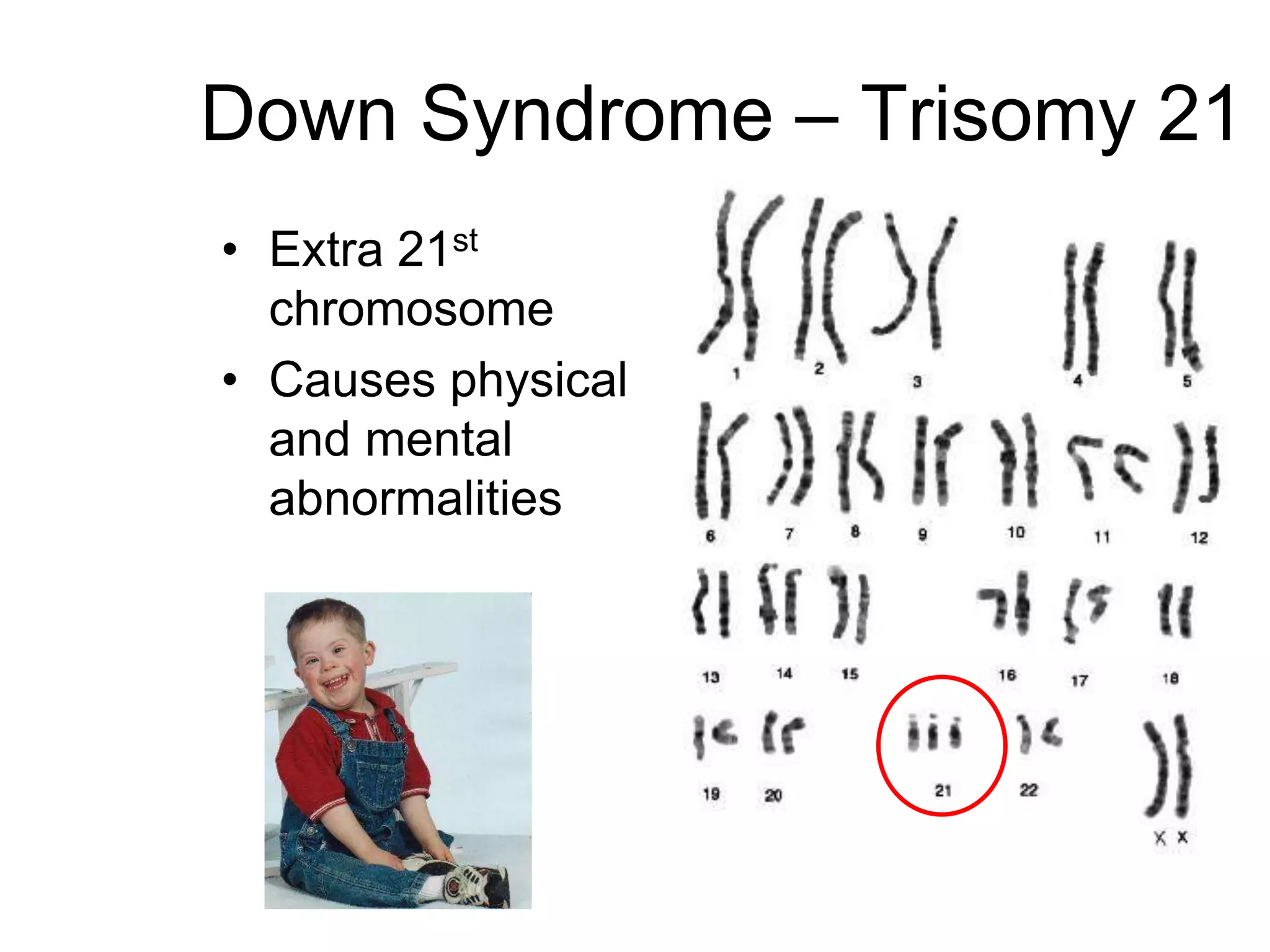 Down Syndrome – Trisomy 21
• Extra 21st
  chromosome
• Causes physical
  and mental
  abnormalities
 