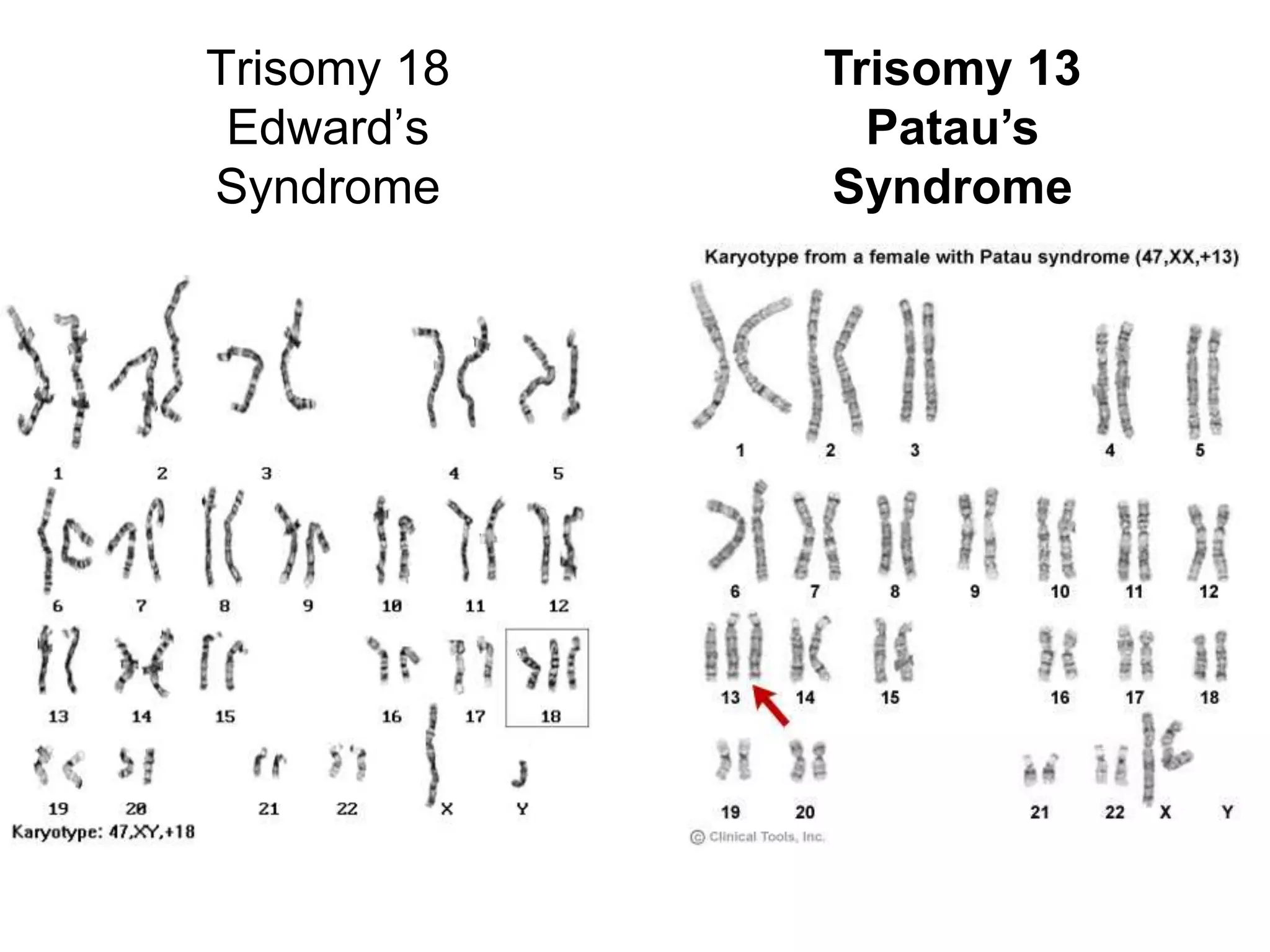 Trisomy 18   Trisomy 13
 Edward’s      Patau’s
Syndrome     Syndrome
 