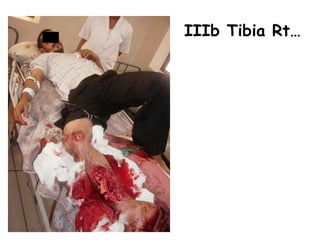 IIIb Tibia Rt…
 