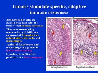 Tumors stimulate specific, adaptive
immune responses
• Although tumor cells areAlthough tumor cells are
derived from host cells, thederived from host cells, the
tumors elicittumors elicit immune responsesimmune responses..
• They are surrounded byThey are surrounded by
mononuclear cell infiltratesmononuclear cell infiltrates
composed ofcomposed of T lymphocytesT lymphocytes,,
natural killer (NK) cellsnatural killer (NK) cells, and, and
macrophagesmacrophages..
• Activated lymphocytes andActivated lymphocytes and
macrophages are present inmacrophages are present in
lymph nodes draininglymph nodes draining..
• Lymphocytic infiltrates isLymphocytic infiltrates is
predictive of apredictive of a betterbetter prognosisprognosis..
 