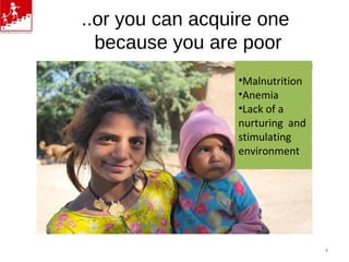 ..or you can acquire one
because you are poor
•Malnutrition
•Anemia
•Lack of a
nurturing and
stimulating
environment
4
 