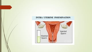 Treatment on Infertility 