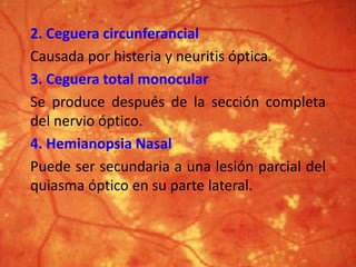 2. Ceguera circunferancial
Causada por histeria y neuritis óptica.
3. Ceguera total monocular
Se produce después de la sección completa
del nervio óptico.
4. Hemianopsia Nasal
Puede ser secundaria a una lesión parcial del
quiasma óptico en su parte lateral.
 
