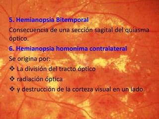 5. Hemianopsia Bitemporal
Consecuencia de una sección sagital del quiasma
óptico.
6. Hemianopsia homonima contralateral
Se origina por:
 La división del tracto óptico
 radiación óptica
 y destrucción de la corteza visual en un lado.
 