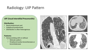 Radiology: UIP Pattern
UIP (Usual Interstitial Pneumonitis)
Distribution:
• Basal predominant and
• Subpleural predominant
• Distribution is often heterogenous
Features:
• Honeycombing with or without
• Reticular pattern
• Peripheral traction bronchiectasis or
bronchiolectasis
 