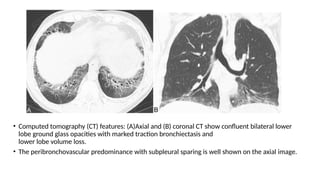 • Computed tomography (CT) features: (A)Axial and (B) coronal CT show confluent bilateral lower
lobe ground glass opacities with marked traction bronchiectasis and
lower lobe volume loss.
• The peribronchovascular predominance with subpleural sparing is well shown on the axial image.
 