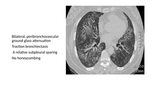 Bilateral, peribronchovascular
ground glass attenuation
Traction bronchiectasis
A relative subpleural sparing
No honeycombing
 