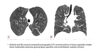 • (A)Axial and (B) coronal computed tomography (CT) reconstructions in heavy cigarette smoker
show moderately extensive ground-glass opacities and centrilobular nodules (circles).
 
