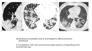 (A) peripheral consolidation and air bronchograms, (B)bronchocentric
distribution
© Consolidation, with more central ground-glass opacity, corresponding to the
reversed halo sign
 