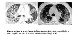 • Honeycombing in acute interstitial pneumonia. Extensive consolidations
with a significant loss of volume and honeycombing (circle)
 
