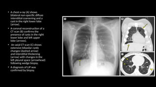 • A chest x-ray (A) shows
bilateral non-specific diffuse
interstitial coarsening and a
cyst in the right lower lobe
(arrow).
• A coronal reconstruction of a
CT scan (B) confirms the
presence of cysts in the right
lower lobe and left upper
lobe (arrows).
• An axial CT scan (C) shows
extensive bibasilar cystic
changes (dashed arrow)
and interstitial thickening
(arrow) with changes in the
left pleural space (arrowhead)
following wedge biopsy.
• A diagnosis of LIP was
confirmed by biopsy.
 