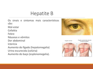 Hepatite B
Os sinais e sintomas mais característicos
são:
Mal-estar
Cefaléia
Febre
Náuseas e vômitos
Dor abdominal
Icterícia
Aumento do fígado (hepatomegalia)
Urina escurecida (colúria)
Aumento do baço (esplenomegalia).
 