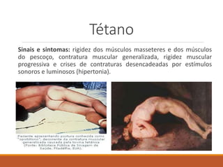 Tétano
Sinais e sintomas: rigidez dos músculos masseteres e dos músculos
do pescoço, contratura muscular generalizada, rigidez muscular
progressiva e crises de contraturas desencadeadas por estímulos
sonoros e luminosos (hipertonia).
 