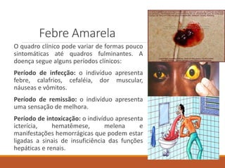 Febre Amarela
O quadro clínico pode variar de formas pouco
sintomáticas até quadros fulminantes. A
doença segue alguns períodos clínicos:
Período de infecção: o indivíduo apresenta
febre, calafrios, cefaléia, dor muscular,
náuseas e vômitos.
Período de remissão: o indivíduo apresenta
uma sensação de melhora.
Período de intoxicação: o indivíduo apresenta
icterícia, hematêmese, melena e
manifestações hemorrágicas que podem estar
ligadas a sinais de insuficiência das funções
hepáticas e renais.
 