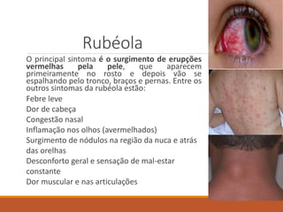 Rubéola
O principal sintoma é o surgimento de erupções
vermelhas pela pele, que aparecem
primeiramente no rosto e depois vão se
espalhando pelo tronco, braços e pernas. Entre os
outros sintomas da rubéola estão:
Febre leve
Dor de cabeça
Congestão nasal
Inflamação nos olhos (avermelhados)
Surgimento de nódulos na região da nuca e atrás
das orelhas
Desconforto geral e sensação de mal-estar
constante
Dor muscular e nas articulações
 