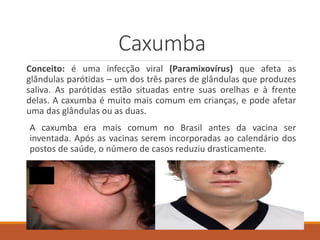 Caxumba
Conceito: é uma infecção viral (Paramixovírus) que afeta as
glândulas parótidas – um dos três pares de glândulas que produzes
saliva. As parótidas estão situadas entre suas orelhas e à frente
delas. A caxumba é muito mais comum em crianças, e pode afetar
uma das glândulas ou as duas.
A caxumba era mais comum no Brasil antes da vacina ser
inventada. Após as vacinas serem incorporadas ao calendário dos
postos de saúde, o número de casos reduziu drasticamente.
 