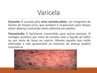 Varicela
Conceito: É causada pelo vírus varicela-zóster, um integrante da
família do herpes-vírus, que também é responsável pela herpes
zóster (doença conhecida como cobreiro) em adultos.
Transmissão: É facilmente transmitida para outras pessoas. O
contágio acontece por meio do contato com o líquido da bolha
ou por meio de tosse ou espirro. Mesmo aqueles que estão
infectados e não apresentam os sintomas da doença podem
transmiti-la.
 