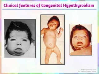 Clinical features of Congenital Hypothyroidism
Dr Naveen Kumar Cheri
S.V. Medical College, Tirupati
 