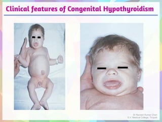 Clinical features of Congenital Hypothyroidism
Dr Naveen Kumar Cheri
S.V. Medical College, Tirupati
 
