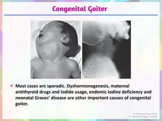 Congenital Goiter
 Most cases are sporadic. Dyshormonogenesis, maternal
antithyroid drugs and Iodide usage, endemic Iodine deficiency and
neonatal Graves’ disease are other important causes of congenital
goiter.
Dr Naveen Kumar Cheri
S.V. Medical College, Tirupati
 