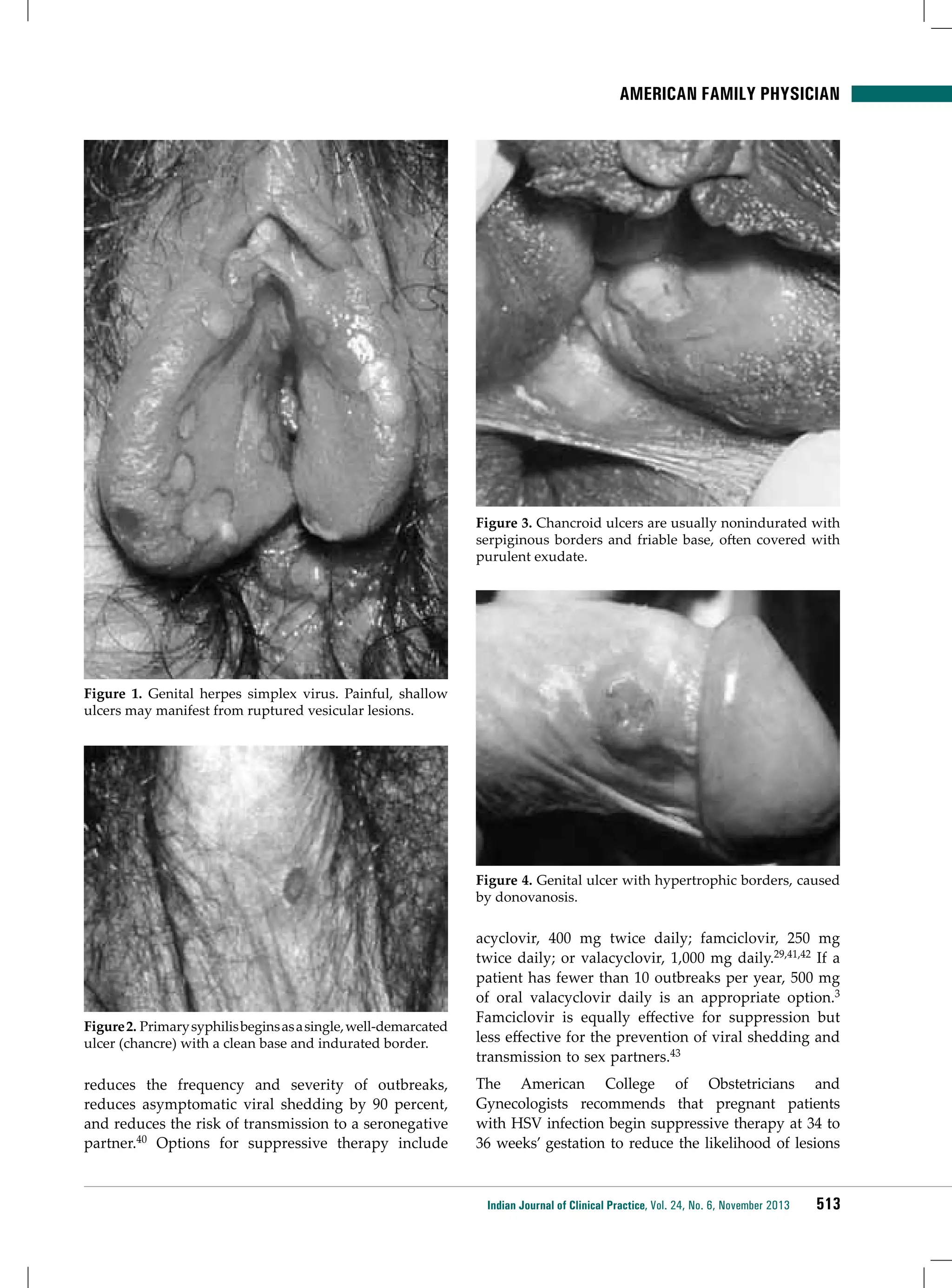 American Family Physician

Figure 3. Chancroid ulcers are usually nonindurated with
serpiginous borders and friable base, often covered with
purulent exudate.

Figure 1. Genital herpes simplex virus. Painful, shallow
ulcers may manifest from ruptured vesicular lesions.

Figure 4. Genital ulcer with hypertrophic borders, caused
by donovanosis.

Figure 2. Primary syphilis begins as a single, well-demarcated
ulcer (chancre) with a clean base and indurated border.

reduces the frequency and severity of outbreaks,
reduces asymptomatic viral shedding by 90 percent,
and reduces the risk of transmission to a seronegative
partner.40 Options for suppressive therapy include

acyclovir, 400 mg twice daily; famciclovir, 250 mg
twice daily; or valacyclovir, 1,000 mg daily.29,41,42 If a
patient has fewer than 10 outbreaks per year, 500 mg
of oral valacyclovir daily is an appropriate option.3
Famciclovir is equally effective for suppression but
less effective for the prevention of viral shedding and
transmission to sex partners.43
The American College of Obstetricians and
Gynecologists recommends that pregnant patients
with HSV infection begin suppressive therapy at 34 to
36 weeks’ gestation to reduce the likelihood of lesions

Indian Journal of Clinical Practice, Vol. 24, No. 6, November 2013

513

 
