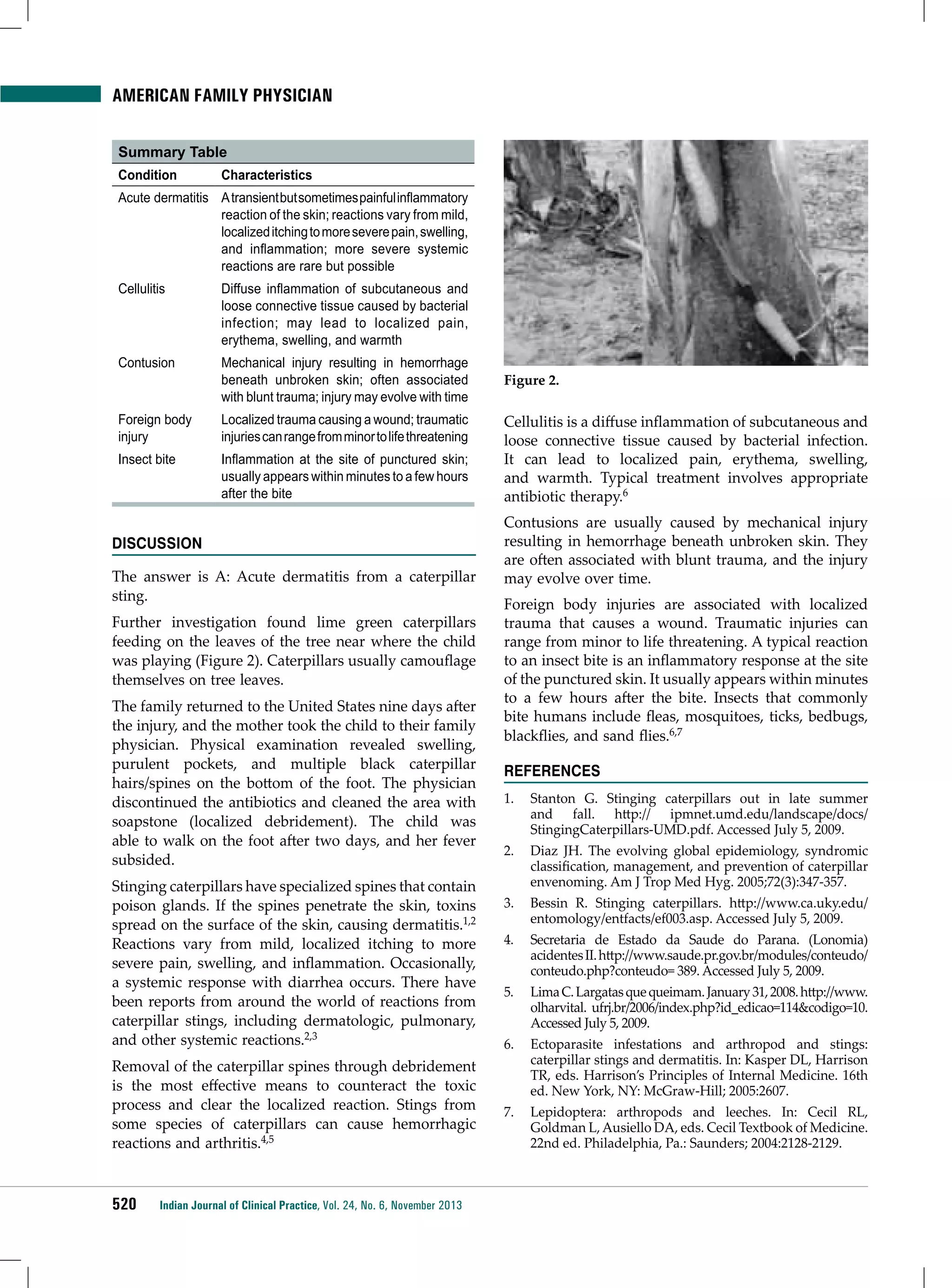 American Family Physician
Summary Table
Condition

Characteristics

Acute dermatitis A transient but sometimes painful inflammatory
reaction of the skin; reactions vary from mild,
localized itching to more severe pain, swelling,
and inflammation; more severe systemic
reactions are rare but possible
Cellulitis

Diffuse inflammation of subcutaneous and
loose connective tissue caused by bacterial
infection; may lead to localized pain,
erythema, swelling, and warmth

Contusion

Mechanical injury resulting in hemorrhage
beneath unbroken skin; often associated
with blunt trauma; injury may evolve with time

Foreign body
injury

Localized trauma causing a wound; traumatic
injuries can range from minor to life threatening

Insect bite

Inflammation at the site of punctured skin;
usually appears within minutes to a few hours
after the bite

Discussion
The answer is A: Acute dermatitis from a caterpillar
sting.
Further investigation found lime green caterpillars
feeding on the leaves of the tree near where the child
was playing (Figure 2). Caterpillars usually camouflage
themselves on tree leaves.
The family returned to the United States nine days after
the injury, and the mother took the child to their family
physician. Physical examination revealed swelling,
purulent pockets, and multiple black caterpillar
hairs/spines on the bottom of the foot. The physician
discontinued the antibiotics and cleaned the area with
soapstone (localized debridement). The child was
able to walk on the foot after two days, and her fever
subsided.
Stinging caterpillars have specialized spines that contain
poison glands. If the spines penetrate the skin, toxins
spread on the surface of the skin, causing dermatitis.1,2
Reactions vary from mild, localized itching to more
severe pain, swelling, and inflammation. Occasionally,
a systemic response with diarrhea occurs. There have
been reports from around the world of reactions from
caterpillar stings, including dermatologic, pulmonary,
and other systemic reactions.2,3
Removal of the caterpillar spines through debridement
is the most effective means to counteract the toxic
process and clear the localized reaction. Stings from
some species of caterpillars can cause hemorrhagic
reactions and arthritis.4,5

520

Indian Journal of Clinical Practice, Vol. 24, No. 6, November 2013

Figure 2.

Cellulitis is a diffuse inflammation of subcutaneous and
loose connective tissue caused by bacterial infection.
It can lead to localized pain, erythema, swelling,
and warmth. Typical treatment involves appropriate
antibiotic therapy.6
Contusions are usually caused by mechanical injury
resulting in hemorrhage beneath unbroken skin. They
are often associated with blunt trauma, and the injury
may evolve over time.
Foreign body injuries are associated with localized
trauma that causes a wound. Traumatic injuries can
range from minor to life threatening. A typical reaction
to an insect bite is an inflammatory response at the site
of the punctured skin. It usually appears within minutes
to a few hours after the bite. Insects that commonly
bite humans include fleas, mosquitoes, ticks, bedbugs,
blackflies, and sand flies.6,7
REFERENCES
1.	 Stanton G. Stinging caterpillars out in late summer
and fall. http:// ipmnet.umd.edu/landscape/docs/
StingingCaterpillars-UMD.pdf. Accessed July 5, 2009.
2.	 Diaz JH. The evolving global epidemiology, syndromic
classification, management, and prevention of caterpillar
envenoming. Am J Trop Med Hyg. 2005;72(3):347-357.
3.	 Bessin R. Stinging caterpillars. http://www.ca.uky.edu/
entomology/entfacts/ef003.asp. Accessed July 5, 2009.
4.	 Secretaria de Estado da Saude do Parana. (Lonomia)
acidentes II. http://www.saude.pr.gov.br/modules/conteudo/
conteudo.php?conteudo= 389. Accessed July 5, 2009.
5.	 Lima C. Largatas que queimam. January 31, 2008. http://www.
olharvital. ufrj.br/2006/index.php?id_edicao=114&codigo=10.
Accessed July 5, 2009.
6.	 Ectoparasite infestations and arthropod and stings:
caterpillar stings and dermatitis. In: Kasper DL, Harrison
TR, eds. Harrison’s Principles of Internal Medicine. 16th
ed. New York, NY: McGraw-Hill; 2005:2607.
7.	 Lepidoptera: arthropods and leeches. In: Cecil RL,
Goldman L, Ausiello DA, eds. Cecil Textbook of Medicine.
22nd ed. Philadelphia, Pa.: Saunders; 2004:2128-2129.

 