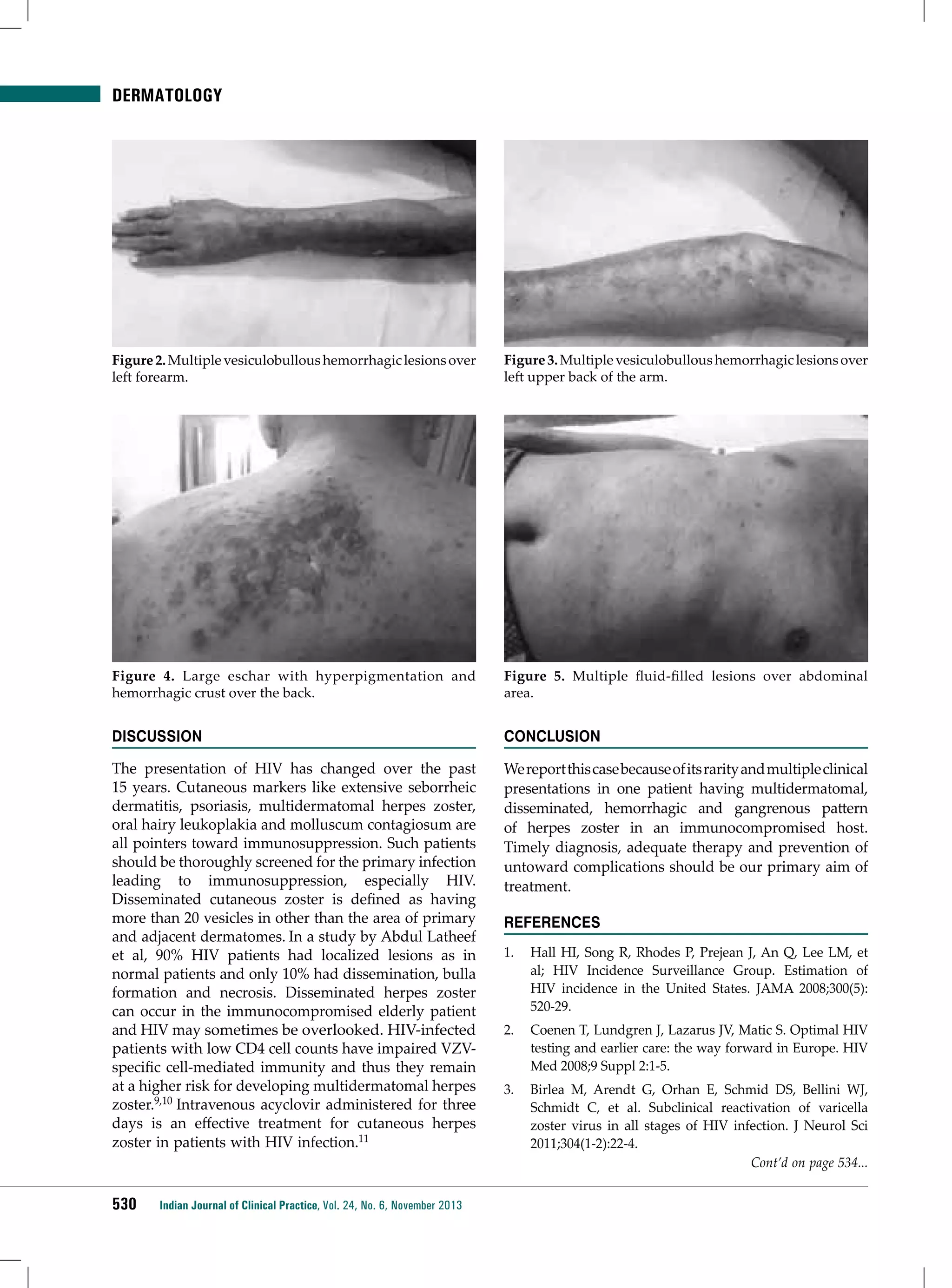 DERMATOLOGY

Figure 2. Multiple vesiculobullous hemorrhagic lesions over
left forearm.

Figure 3. Multiple vesiculobullous hemorrhagic lesions over
left upper back of the arm.

Figure 4. Large eschar with hyperpigmentation and
hemorrhagic crust over the back.

Figure 5. Multiple fluid-filled lesions over abdominal
area.

Discussion

Conclusion

The presentation of HIV has changed over the past
15 years. Cutaneous markers like extensive seborrheic
dermatitis, psoriasis, multidermatomal herpes zoster,
oral hairy leukoplakia and molluscum contagiosum are
all pointers toward immunosuppression. Such patients
should be thoroughly screened for the primary infection
leading to immunosuppression, especially HIV.
Disseminated cutaneous zoster is defined as having
more than 20 vesicles in other than the area of primary
and adjacent dermatomes. In a study by Abdul Latheef
et al, 90% HIV patients had localized lesions as in
normal patients and only 10% had dissemination, bulla
formation and necrosis. Disseminated herpes zoster
can occur in the immunocompromised elderly patient
and HIV may sometimes be overlooked. HIV-infected
patients with low CD4 cell counts have impaired VZVspecific cell-mediated immunity and thus they remain
at a higher risk for developing multidermatomal herpes
zoster.9,10 Intravenous acyclovir administered for three
days is an effective treatment for cutaneous herpes
zoster in patients with HIV infection.11

We report this case because of its rarity and multiple clinical
presentations in one patient having multidermatomal,
disseminated, hemorrhagic and gangrenous pattern
of herpes zoster in an immunocompromised host.
Timely diagnosis, adequate therapy and prevention of
untoward complications should be our primary aim of
treatment.

530

Indian Journal of Clinical Practice, Vol. 24, No. 6, November 2013

REFERENCES
1.	 Hall HI, Song R, Rhodes P, Prejean J, An Q, Lee LM, et
al; HIV Incidence Surveillance Group. Estimation of
HIV incidence in the United States. JAMA 2008;300(5):
520-29.
2.	 Coenen T, Lundgren J, Lazarus JV, Matic S. Optimal HIV
testing and earlier care: the way forward in Europe. HIV
Med 2008;9 Suppl 2:1-5.
3.	 Birlea M, Arendt G, Orhan E, Schmid DS, Bellini WJ,
Schmidt C, et al. Subclinical reactivation of varicella
zoster virus in all stages of HIV infection. J Neurol Sci
2011;304(1-2):22-4.
Cont’d on page 534...

 