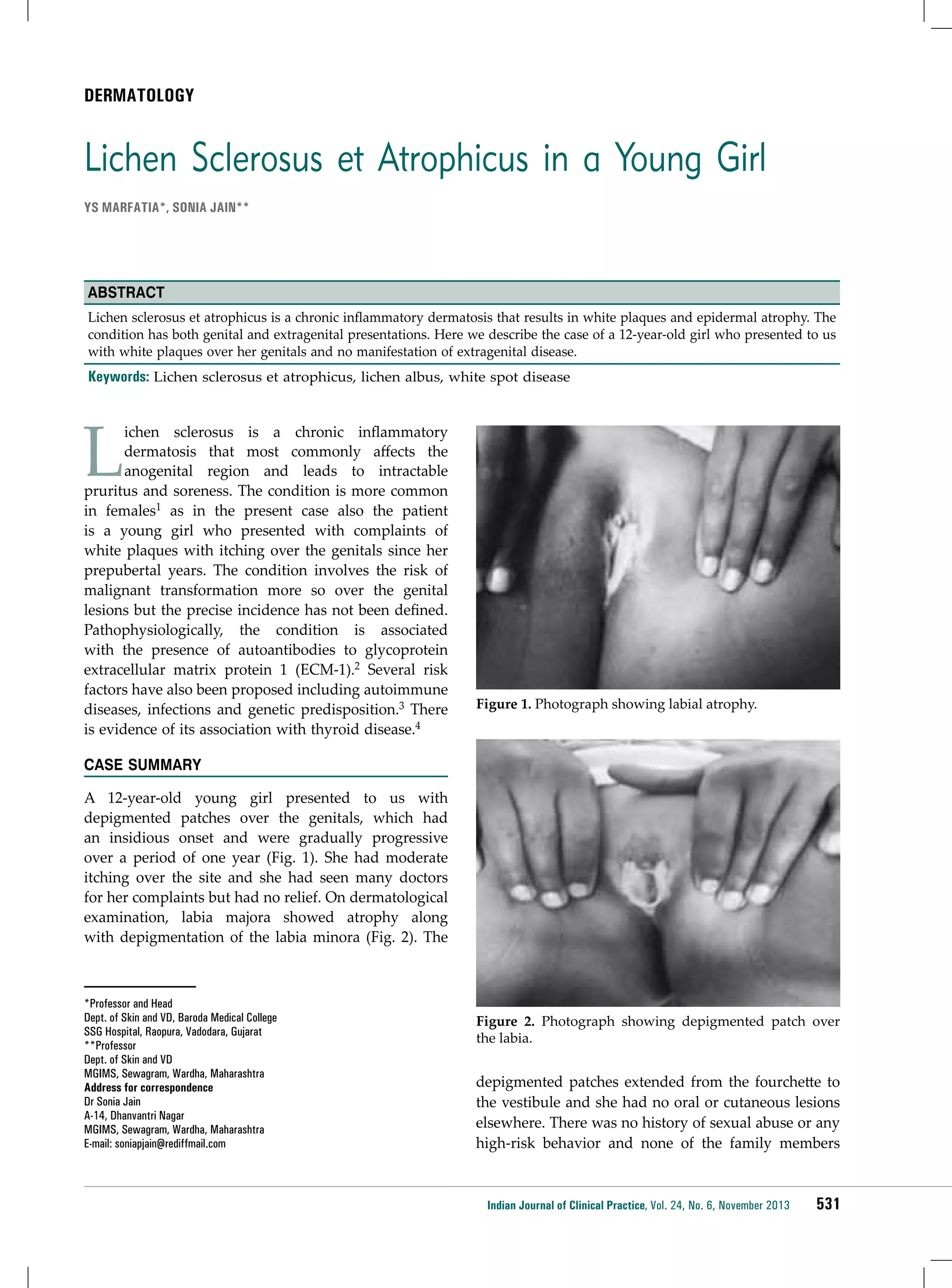 DERMATOLOGY

Lichen Sclerosus et Atrophicus in a Young Girl
YS Marfatia*, SoNIA JAIN**

Abstract
Lichen sclerosus et atrophicus is a chronic inflammatory dermatosis that results in white plaques and epidermal atrophy. The
condition has both genital and extragenital presentations. Here we describe the case of a 12-year-old girl who presented to us
with white plaques over her genitals and no manifestation of extragenital disease.

Keywords: Lichen sclerosus et atrophicus, lichen albus, white spot disease

L

ichen sclerosus is a chronic inflammatory
dermatosis that most commonly affects the
anogenital region and leads to intractable
pruritus and soreness. The condition is more common
in females1 as in the present case also the patient
is a young girl who presented with complaints of
white plaques with itching over the genitals since her
prepubertal years. The condition involves the risk of
malignant transformation more so over the genital
lesions but the precise incidence has not been defined.
Pathophysiologically, the condition is associated
with the presence of autoantibodies to glycoprotein
extracellular matrix protein 1 (ECM-1).2 Several risk
factors have also been proposed including autoimmune
diseases, infections and genetic predisposition.3 There
is evidence of its association with thyroid disease.4

Figure 1. Photograph showing labial atrophy.

CASE SUMMARY
A 12-year-old young girl presented to us with
depigmented patches over the genitals, which had
an insidious onset and were gradually progressive
over a period of one year (Fig. 1). She had moderate
itching over the site and she had seen many doctors
for her complaints but had no relief. On dermatological
examination, labia majora showed atrophy along
with depigmentation of the labia minora (Fig. 2). The

*Professor and Head
Dept. of Skin and VD, Baroda Medical College
SSG Hospital, Raopura, Vadodara, Gujarat
**Professor
Dept. of Skin and VD
MGIMS, Sewagram, Wardha, Maharashtra
Address for correspondence
Dr Sonia Jain
A-14, Dhanvantri Nagar
MGIMS, Sewagram, Wardha, Maharashtra
E-mail: soniapjain@rediffmail.com

Figure 2. Photograph showing depigmented patch over
the labia.

depigmented patches extended from the fourchette to
the vestibule and she had no oral or cutaneous lesions
elsewhere. There was no history of sexual abuse or any
high-risk behavior and none of the family members

Indian Journal of Clinical Practice, Vol. 24, No. 6, November 2013

531

 