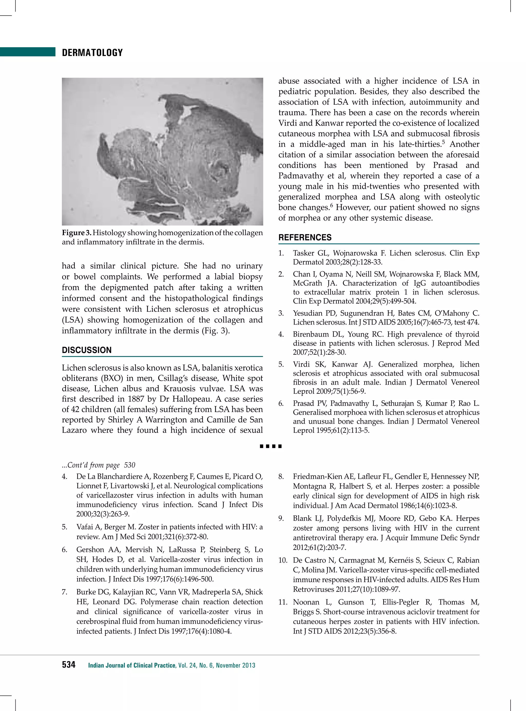 DERMATOLOGY
abuse associated with a higher incidence of LSA in
pediatric population. Besides, they also described the
association of LSA with infection, autoimmunity and
trauma. There has been a case on the records wherein
Virdi and Kanwar reported the co-existence of localized
cutaneous morphea with LSA and submucosal fibrosis
in a middle-aged man in his late-thirties.5 Another
citation of a similar association between the aforesaid
conditions has been mentioned by Prasad and
Padmavathy et al, wherein they reported a case of a
young male in his mid-twenties who presented with
generalized morphea and LSA along with osteolytic
bone changes.6 However, our patient showed no signs
of morphea or any other systemic disease.
Figure 3. Histology showing homogenization of the collagen
and inflammatory infiltrate in the dermis.

had a similar clinical picture. She had no urinary
or bowel complaints. We performed a labial biopsy
from the depigmented patch after taking a written
informed consent and the histopathological findings
were consistent with Lichen sclerosus et atrophicus
(LSA) showing homogenization of the collagen and
inflammatory infiltrate in the dermis (Fig. 3).
DISCUSSION
Lichen sclerosus is also known as LSA, balanitis xerotica
obliterans (BXO) in men, Csillag’s disease, White spot
disease, Lichen albus and Krauosis vulvae. LSA was
first described in 1887 by Dr Hallopeau. A case series
of 42 children (all females) suffering from LSA has been
reported by Shirley A Warrington and Camille de San
Lazaro where they found a high incidence of sexual

REFERENCES
1.	 Tasker GL, Wojnarowska F. Lichen sclerosus. Clin Exp
Dermatol 2003;28(2):128-33.
2.	 Chan I, Oyama N, Neill SM, Wojnarowska F, Black MM,
McGrath JA. Characterization of IgG autoantibodies
to extracellular matrix protein 1 in lichen sclerosus.
Clin Exp Dermatol 2004;29(5):499-504.
3.	 Yesudian PD, Sugunendran H, Bates CM, O’Mahony C.
Lichen sclerosus. Int J STD AIDS 2005;16(7):465-73, test 474.
4.	 Birenbaum DL, Young RC. High prevalence of thyroid
disease in patients with lichen sclerosus. J Reprod Med
2007;52(1):28-30.
5.	 Virdi SK, Kanwar AJ. Generalized morphea, lichen
sclerosis et atrophicus associated with oral submucosal
fibrosis in an adult male. Indian J Dermatol Venereol
Leprol 2009;75(1):56-9.
6.	 Prasad PV, Padmavathy L, Sethurajan S, Kumar P, Rao L.
Generalised morphoea with lichen sclerosus et atrophicus
and unusual bone changes. Indian J Dermatol Venereol
Leprol 1995;61(2):113-5.

■■■■
...Cont’d from page 530
4.	 De La Blanchardiere A, Rozenberg F, Caumes E, Picard O,
Lionnet F, Livartowski J, et al. Neurological complications
of varicellazoster virus infection in adults with human
immunodeficiency virus infection. Scand J Infect Dis
2000;32(3):263-9.
5.	 Vafai A, Berger M. Zoster in patients infected with HIV: a
review. Am J Med Sci 2001;321(6):372-80.
6.	 Gershon AA, Mervish N, LaRussa P, Steinberg S, Lo
SH, Hodes D, et al. Varicella-zoster virus infection in
children with underlying human immunodeficiency virus
infection. J Infect Dis 1997;176(6):1496-500.
7.	 Burke DG, Kalayjian RC, Vann VR, Madreperla SA, Shick
HE, Leonard DG. Polymerase chain reaction detection
and clinical significance of varicella-zoster virus in
cerebrospinal fluid from human immunodeficiency virusinfected patients. J Infect Dis 1997;176(4):1080-4.

534

Indian Journal of Clinical Practice, Vol. 24, No. 6, November 2013

8.	 Friedman-Kien AE, Lafleur FL, Gendler E, Hennessey NP,
Montagna R, Halbert S, et al. Herpes zoster: a possible
early clinical sign for development of AIDS in high risk
individual. J Am Acad Dermatol 1986;14(6):1023-8.
9.	 Blank LJ, Polydefkis MJ, Moore RD, Gebo KA. Herpes
zoster among persons living with HIV in the current
antiretroviral therapy era. J Acquir Immune Defic Syndr
2012;61(2):203-7.
10.	 De Castro N, Carmagnat M, Kernéis S, Scieux C, Rabian
C, Molina JM. Varicella-zoster virus-specific cell-mediated
immune responses in HIV-infected adults. AIDS Res Hum
Retroviruses 2011;27(10):1089-97.
11.	 Noonan L, Gunson T, Ellis-Pegler R, Thomas M,
Briggs S. Short-course intravenous aciclovir treatment for
cutaneous herpes zoster in patients with HIV infection.
Int J STD AIDS 2012;23(5):356-8.

 