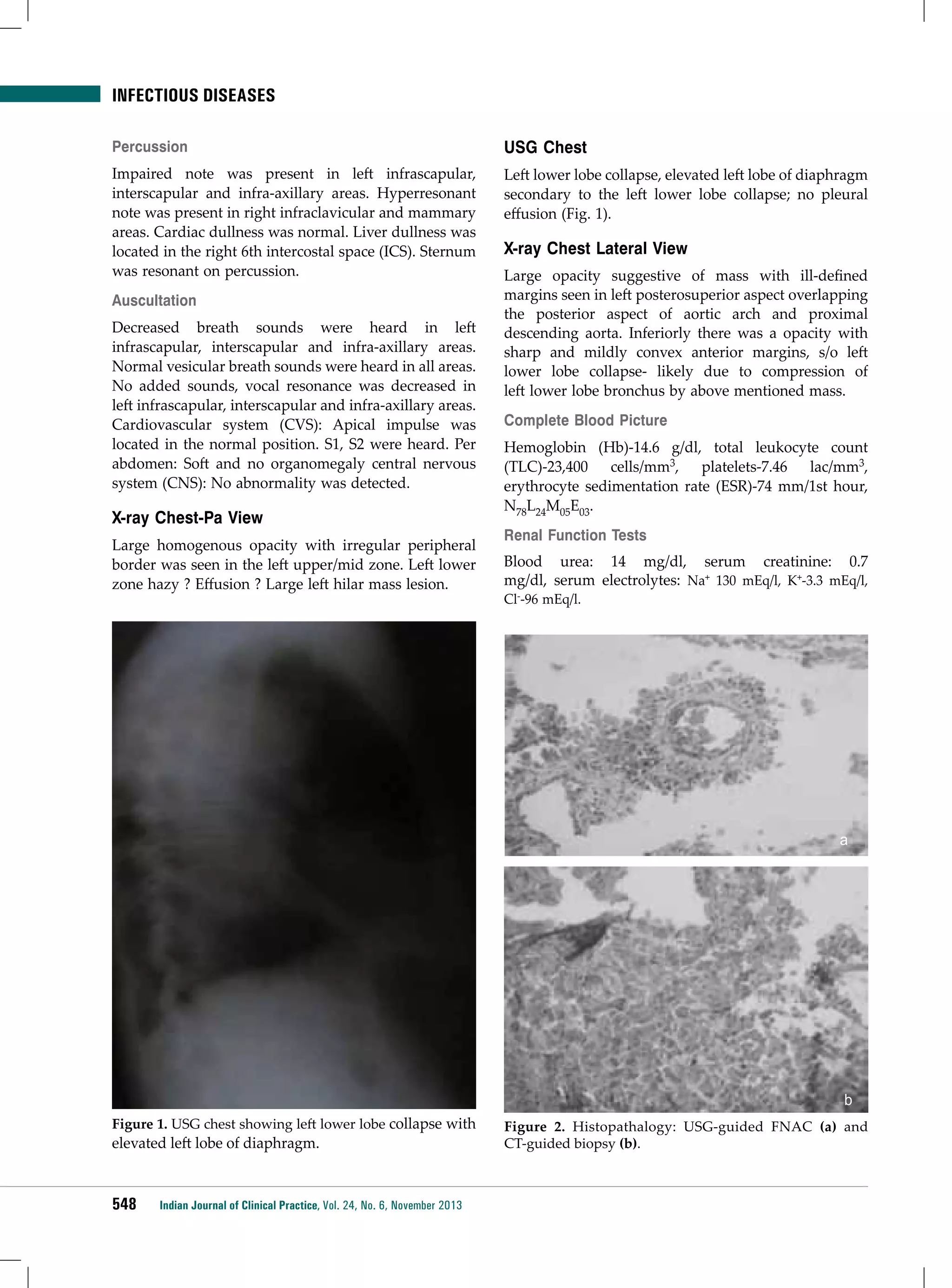 infectious diseases
Percussion

USG Chest

Impaired note was present in left infrascapular,
interscapular and infra-axillary areas. Hyperresonant
note was present in right infraclavicular and mammary
areas. Cardiac dullness was normal. Liver dullness was
located in the right 6th intercostal space (ICS). Sternum
was resonant on percussion.

Left lower lobe collapse, elevated left lobe of diaphragm
secondary to the left lower lobe collapse; no pleural
effusion (Fig. 1).

Auscultation
Decreased breath sounds were heard in left
infrascapular, interscapular and infra-axillary areas.
Normal vesicular breath sounds were heard in all areas.
No added sounds, vocal resonance was decreased in
left infrascapular, interscapular and infra-axillary areas.
Cardiovascular system (CVS): Apical impulse was
located in the normal position. S1, S2 were heard. Per
abdomen: Soft and no organomegaly central nervous
system (CNS): No abnormality was detected.

X-ray Chest-Pa View
Large homogenous opacity with irregular peripheral
border was seen in the left upper/mid zone. Left lower
zone hazy ? Effusion ? Large left hilar mass lesion.

X-ray Chest Lateral View
Large opacity suggestive of mass with ill-defined
margins seen in left posterosuperior aspect overlapping
the posterior aspect of aortic arch and proximal
descending aorta. Inferiorly there was a opacity with
sharp and mildly convex anterior margins, s/o left
lower lobe collapse- likely due to compression of
left lower lobe bronchus by above mentioned mass.
Complete Blood Picture
Hemoglobin (Hb)-14.6 g/dl, total leukocyte count
(TLC)-23,400 cells/mm3, platelets-7.46 lac/mm3,
erythrocyte sedimentation rate (ESR)-74 mm/1st hour,
N78L24M05E03.
Renal Function Tests
Blood urea: 14 mg/dl, serum creatinine: 0.7
mg/dl, serum electrolytes: Na+ 130 mEq/l, K+-3.3 mEq/l,
Cl--96 mEq/l.

a

b
Figure 1. USG chest showing left lower lobe collapse with

elevated left lobe of diaphragm.

548

Indian Journal of Clinical Practice, Vol. 24, No. 6, November 2013

Figure 2. Histopathalogy: USG-guided FNAC (a) and
CT-guided biopsy (b).

 