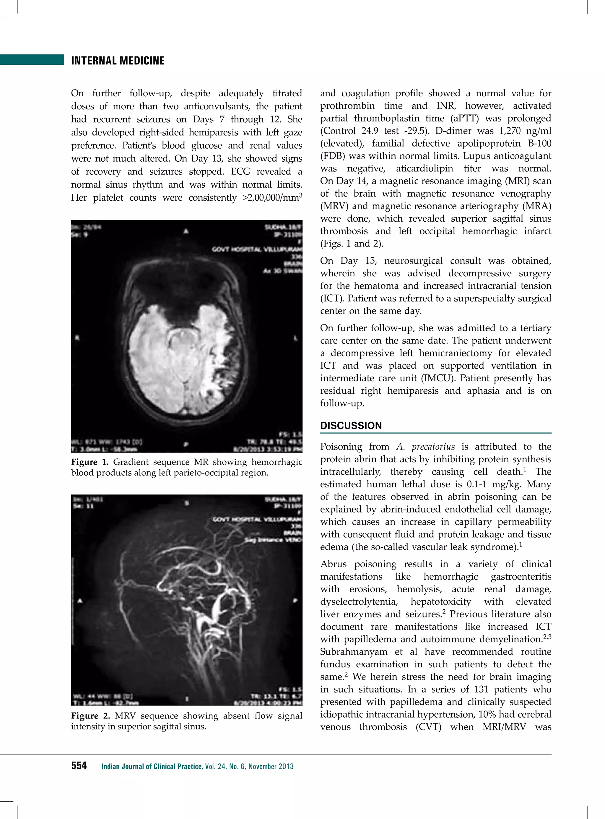 INTERNAL MEDICINE
On further follow-up, despite adequately titrated
doses of more than two anticonvulsants, the patient
had recurrent seizures on Days 7 through 12. She
also developed right-sided hemiparesis with left gaze
preference. Patient’s blood glucose and renal values
were not much altered. On Day 13, she showed signs
of recovery and seizures stopped. ECG revealed a
normal sinus rhythm and was within normal limits.
Her platelet counts were consistently >2,00,000/mm3

and coagulation profile showed a normal value for
prothrombin time and INR, however, activated
partial thromboplastin time (aPTT) was prolonged
(Control 24.9 test -29.5). D-dimer was 1,270 ng/ml
(elevated), familial defective apolipoprotein B-100
(FDB) was within normal limits. Lupus anticoagulant
was negative, aticardiolipin titer was normal.
On Day 14, a magnetic resonance imaging (MRI) scan
of the brain with magnetic resonance venography
(MRV) and magnetic resonance arteriography (MRA)
were done, which revealed superior sagittal sinus
thrombosis and left occipital hemorrhagic infarct
(Figs. 1 and 2).
On Day 15, neurosurgical consult was obtained,
wherein she was advised decompressive surgery
for the hematoma and increased intracranial tension
(ICT). Patient was referred to a superspecialty surgical
center on the same day.
On further follow-up, she was admitted to a tertiary
care center on the same date. The patient underwent
a decompressive left hemicraniectomy for elevated
ICT and was placed on supported ventilation in
intermediate care unit (IMCU). Patient presently has
residual right hemiparesis and aphasia and is on
follow-up.
DISCUSSION

Figure 1. Gradient sequence MR showing hemorrhagic
blood products along left parieto-occipital region.

Figure 2. MRV sequence showing absent flow signal
intensity in superior sagittal sinus.

554

Indian Journal of Clinical Practice, Vol. 24, No. 6, November 2013

Poisoning from A. precatorius is attributed to the
protein abrin that acts by inhibiting protein synthesis
intracellularly, thereby causing cell death.1 The
estimated human lethal dose is 0.1-1 mg/kg. Many
of the features observed in abrin poisoning can be
explained by abrin-induced endothelial cell damage,
which causes an increase in capillary permeability
with consequent fluid and protein leakage and tissue
edema (the so-called vascular leak syndrome).1
Abrus poisoning results in a variety of clinical
manifestations like hemorrhagic gastroenteritis
with erosions, hemolysis, acute renal damage,
dyselectrolytemia, hepatotoxicity with elevated
liver enzymes and seizures.2 Previous literature also
document rare manifestations like increased ICT
with papilledema and autoimmune demyelination.2,3
Subrahmanyam et al have recommended routine
fundus examination in such patients to detect the
same.2 We herein stress the need for brain imaging
in such situations. In a series of 131 patients who
presented with papilledema and clinically suspected
idiopathic intracranial hypertension, 10% had cerebral
venous thrombosis (CVT) when MRI/MRV was

 